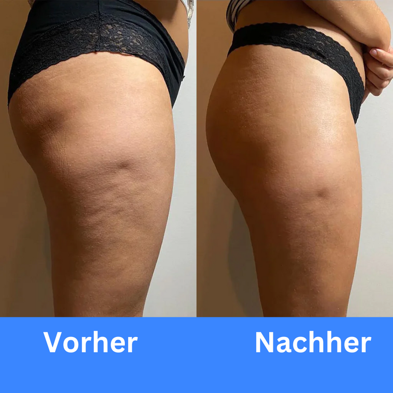 SmartSchröpfer - Schröpfen gegen Cellulite